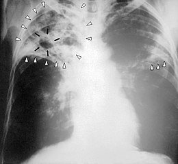 Un cas de tuberculose à Sainte-Foy Un cas de tuberculose à Sainte-Foy